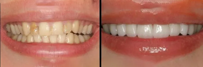 before and after teeth