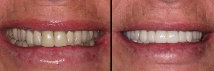 before-after-dental-work