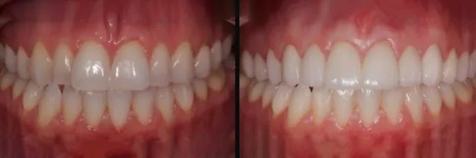 before-after-dental-work