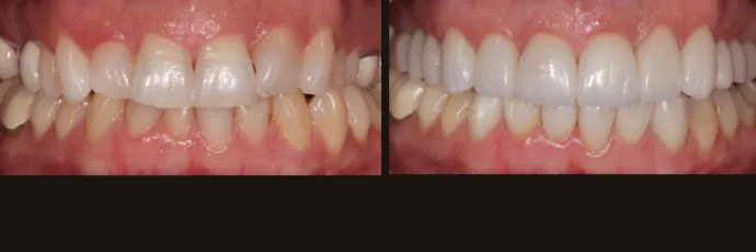 before-after-dentist