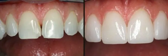 before-after-dentist