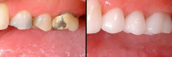before-after-dentist