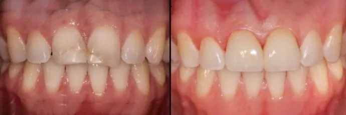 before-after-dentist