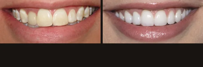 before-after-dentist