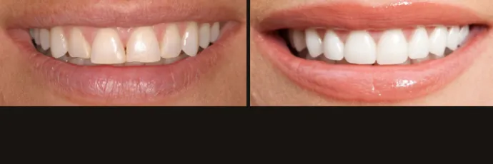 before-after-dentist