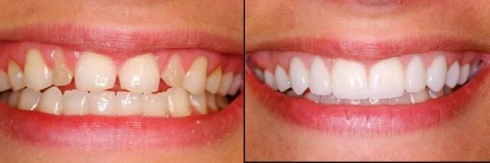 before and after teeth