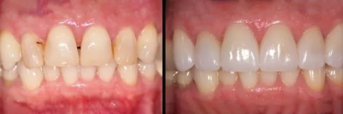 before and after dentist