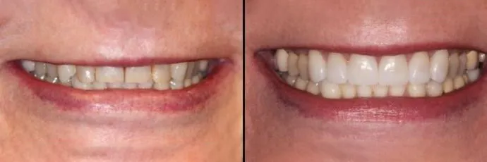 before and after dentist