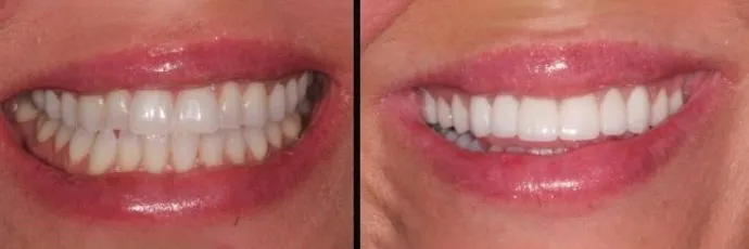 before and after dentist