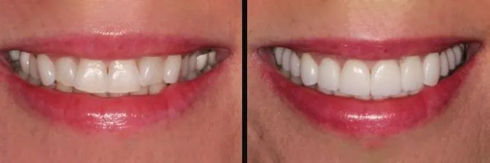 before and after teeth
