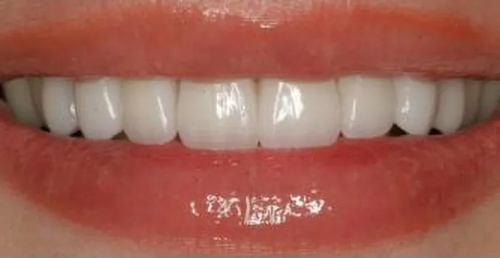 smile after
