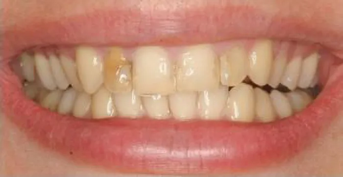 smile before