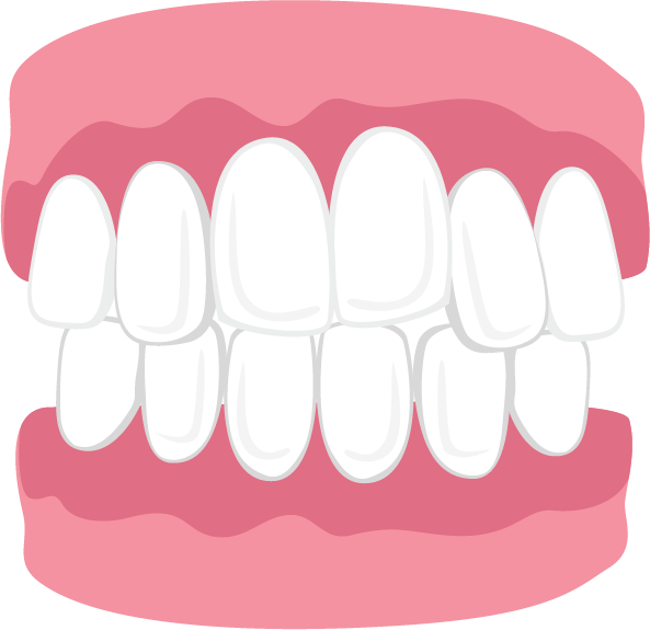 Crossbite