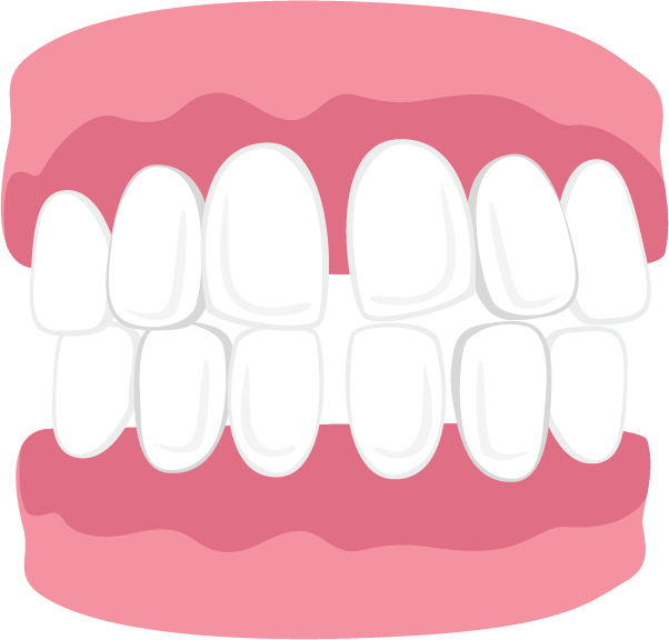 Gapped Teeth