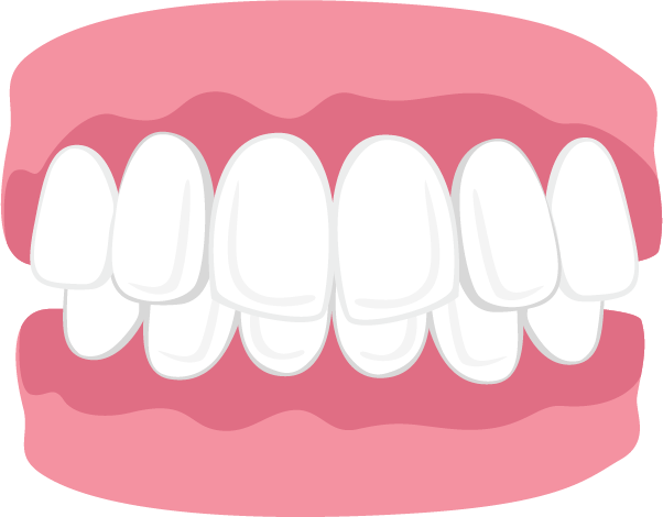 Overbite