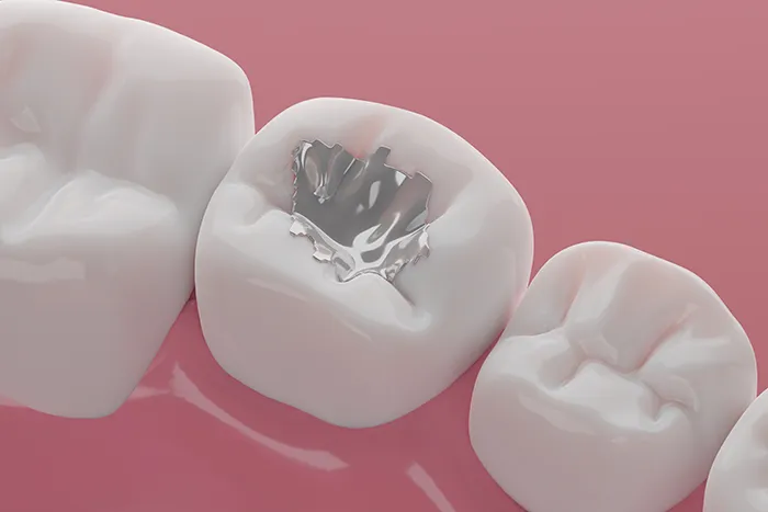 root canal