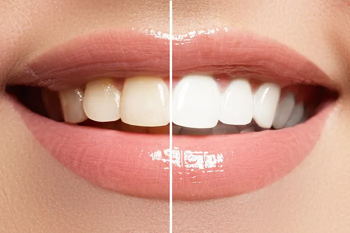 Teeth Whitening Teeth Whitening