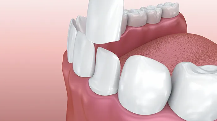 Porcelain Veneers